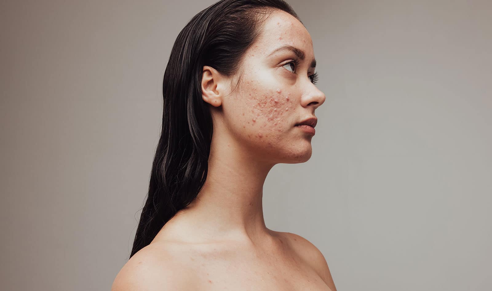 Does Smoking Weed Cause Acne? - Recreate Behavioral Health Network
